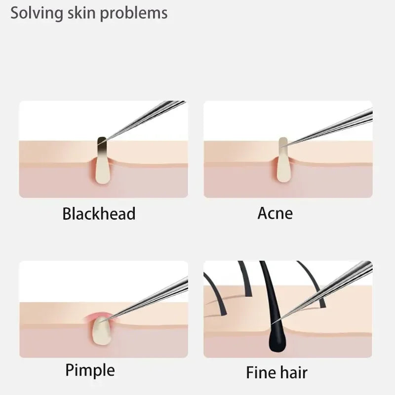 1/11Pcs Acne Pimples Blackhead Remover Clip Ultra-fine Tweezers