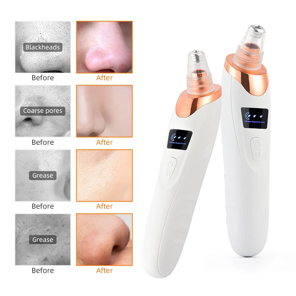 Vacuum Nose Blackhead Remover